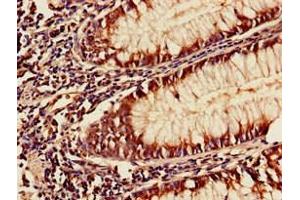 Immunohistochemistry of paraffin-embedded human colon cancer using ABIN7175954 at dilution of 1:100 (YAF2 anticorps  (AA 1-204))