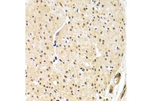 Immunohistochemistry of paraffin-embedded human gastric cancer using TERF1 antibody (ABIN6292425) at dilution of 1:200 (40x lens). (TRF1 anticorps)