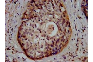 IHC image of ABIN7154126 diluted at 1:500 and staining in paraffin-embedded human cervical cancer performed on a Leica BondTM system.