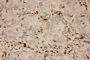 Anti-COX1 Picoband antibody,  IHC(P): Human Mammary Cancer Tissue (PTGS1 anticorps  (AA 318-599))