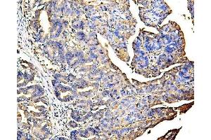 IHC analysis of Galectin 3/LGALS3 using anti Galectin 3/LGALS3 antibody (ABIN6719486).