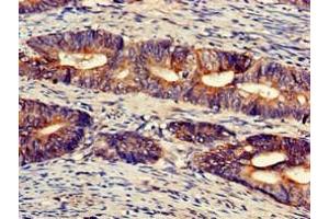 Immunohistochemistry of paraffin-embedded human colon cancer using ABIN7174508 at dilution of 1:100 (UFM1 anticorps  (AA 11-63))