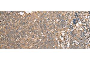 Immunohistochemistry of paraffin-embedded Human cervical cancer tissue using ECI1 Polyclonal Antibody at dilution of 1:30(x200) (DCI anticorps)