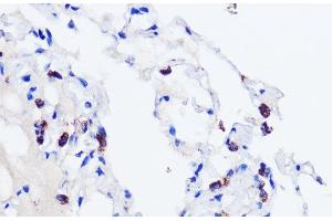 Immunohistochemistry of paraffin-embedded Human lung using SFTPC Polyclonal Antibody at dilution of 1:200 (40x lens). (Surfactant Protein C anticorps)
