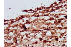IHC image of ABIN7162742 diluted at 1:500 and staining in paraffin-embedded human melanoma performed on a Leica BondTM system. (SLC26A4 anticorps  (AA 592-655))