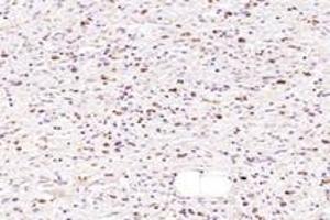 Immunohistochemistry analysis of paraffin-embedded human gastric cancer using NMU (ABIN7074818) at dilution of 1: 1000