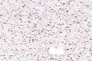 Immunohistochemistry analysis of paraffin-embedded human gastric cancer using NMU (ABIN7074818) at dilution of 1: 1000 (Neuromedin U anticorps)