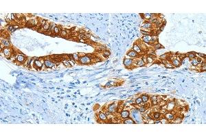 Immunohistochemistry of paraffin-embedded Human cervical cancer using KRT40 Polyclonal Antibody at dilution of 1:50 (KRT40 anticorps)