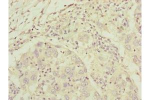 Immunohistochemistry of paraffin-embedded human liver cancer using ABIN7148369 at dilution of 1:100 (C8A anticorps  (AA 310-460))