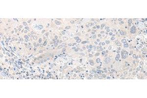 Immunohistochemistry of paraffin-embedded Human cervical cancer tissue using TIMM8A Polyclonal Antibody at dilution of 1:50(x200) (TIMM8A/DDP anticorps)