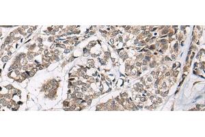Immunohistochemistry of paraffin-embedded Human esophagus cancer tissue using CACNB3 Polyclonal Antibody at dilution of 1:55(x200)