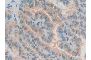 Detection of GDF10 in Human Thyroid cancer Tissue using Polyclonal Antibody to Growth Differentiation Factor 10 (GDF10)