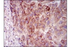Immunohistochemical analysis of paraffin-embedded liver cancer tissues using PRKACG mouse mAb with DAB staining.