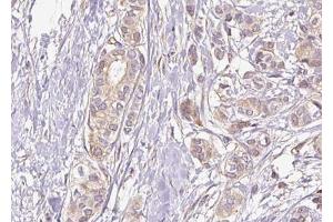 ABIN6267430 at 1/100 staining human breast carcinoma tissue sections by IHC-P.
