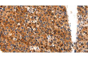 Immunohistochemistry of paraffin-embedded Human liver cancer tissue using FGFR1 Polyclonal Antibody at dilution 1:60 (FGFR1 anticorps)