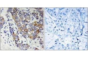 Immunohistochemistry analysis of paraffin-embedded human breast carcinoma tissue, using CBR1 Antibody. (CBR1 anticorps  (AA 181-230))
