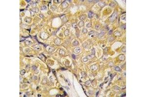 IHC analysis of FFPE human prostate carcinoma tissue stained with TRPM8 antibody (TRPM8 anticorps  (AA 521-552))