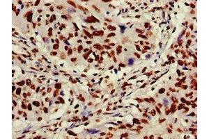 Immunohistochemistry of paraffin-embedded human lung cancer using ABIN7175905 at dilution of 1:100 (XRCC6 anticorps  (AA 2-609))