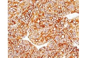 Formalin-fixed, paraffin-embedded human colon carcinoma stained with Cytokeratin 18 antibody. (Cytokeratin 18 anticorps)