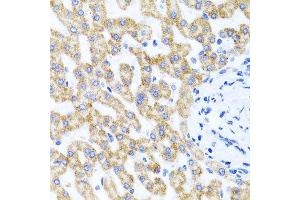 Immunohistochemistry of paraffin-embedded human liver injury using RIPK4 antibody at dilution of 1:100 (x40 lens).