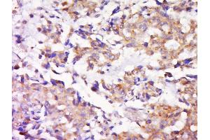 Paraformaldehyde-fixed, paraffin embedded human lung carcinoma, Antigen retrieval by boiling in sodium citrate buffer (pH6) for 15min, Block endogenous peroxidase by 3% hydrogen peroxide for 30 minutes, Blocking buffer (normal goat serum) at 37°C for 20min, Antibody incubation with Rabbit Anti-MEK1/2 Polyclonal Antibody, Unconjugated  at 1:500 overnight at 4°C, followed by a conjugated secondary and DAB staining. (MEK1/2 anticorps  (AA 301-393))