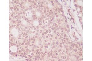 Immunohistochemical analysis of paraffin-embedded human breast carcinoma, using eIF4EBP1 Antibody.