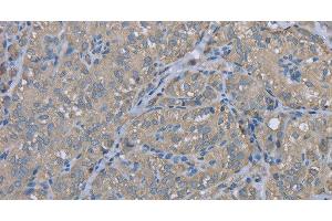 Immunohistochemistry of paraffin-embedded Human thyroid cancer using EZR Polyclonal Antibody at dilution of 1:30