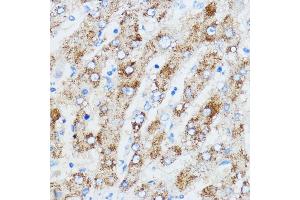 Immunohistochemistry of paraffin-embedded human liver using IGF2BP3 antibody (ABIN6131800, ABIN6142245, ABIN6142246 and ABIN6221706) at dilution of 1:100 (40x lens).