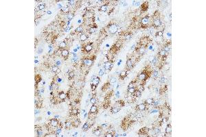 Immunohistochemistry of paraffin-embedded human liver using IGF2BP3 antibody (ABIN6131800, ABIN6142245, ABIN6142246 and ABIN6221706) at dilution of 1:100 (40x lens). (IGF2BP3 anticorps  (AA 300-579))