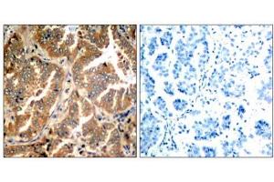 Immunohistochemical analysis of paraffin- embedded human lung carcinoma tissue using ADD1 (Ab-726) antibody (E021189). (alpha Adducin anticorps)