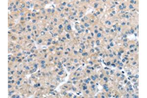 The image on the left is immunohistochemistry of paraffin-embedded Human liver cancer tissue using ABIN7127970(ITPA Antibody) at dilution 1/25, on the right is treated with fusion protein. (ITPA anticorps)