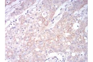 Immunohistochemical analysis of paraffin-embedded stomach cancer tissues using LRP1 mouse mAb with DAB staining. (LRP1 anticorps  (AA 20-155))