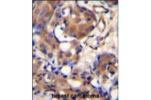 KNG1 Antibody immunohistochemistry analysis in formalin fixed and paraffin embedded human breast carcinoma followed by peroxidase conjugation of the secondary antibody and DAB staining. (KNG1 anticorps  (N-Term))