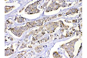 MUT was detected in paraffin-embedded sections of human lung cancer tissues using rabbit anti- MUT Antigen Affinity purified polyclonal antibody (Catalog # ) at 1 µg/mL. (MUT anticorps  (N-Term))