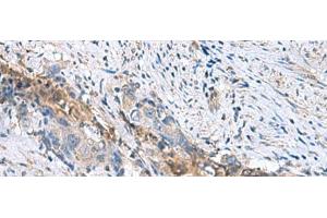 Immunohistochemistry of paraffin-embedded Human cervical cancer tissue using RNF208 Polyclonal Antibody at dilution of 1:55(x200) (RNF208 anticorps)