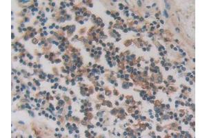 IHC-P analysis of Human Stomach cancer Tissue, with DAB staining. (PKIG anticorps  (AA 1-76))