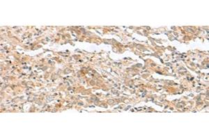 Immunohistochemistry of paraffin-embedded Human cervical cancer tissue using TTC12 Polyclonal Antibody at dilution of 1:40(x200) (TTC12 anticorps)