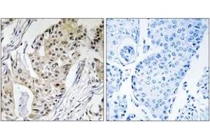 Immunohistochemistry analysis of paraffin-embedded human breast carcinoma tissue, using POLE4 Antibody. (POLE4 anticorps  (AA 61-110))