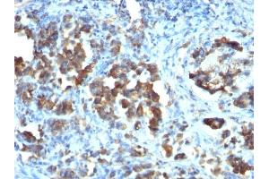 Formalin-fixed, paraffin-embedded human Gastric carcinoma stained with CDC20 Monoclonal Antibody (CDC20/1102) (CDC20 anticorps)