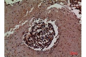 Immunohistochemistry (IHC) analysis of paraffin-embedded Human Lung Cancer, antibody was diluted at 1:100.