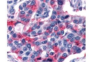 Anti-GPR80 / GPR99 / OXGR1 antibody IHC of human Lung, Non-Small Cell Carcinoma. (OXGR1 anticorps  (Extracellular Domain))