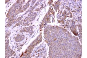 IHC-P Image CXCR1 antibody [C2C3], C-term detects CXCR1 protein at cytosol on human breast carcinoma by immunohistochemical analysis. (CXCR1 anticorps  (C-Term))