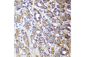 Immunohistochemistry of paraffin-embedded Human liver cancer using NDUF Rabbit pAb (ABIN7268807) at dilution of 1:100 (40x lens).