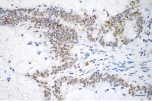 Immunohistochemistry was performed on paraffin-embedded human sigmoid colon carcinoma using BRMS1 antibody (ABIN7797793), 1:200).