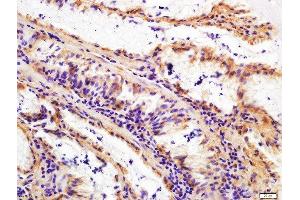 Paraformaldehyde-fixed, paraffin embedded human gastric cancer, Antigen retrieval by boiling in sodium citrate buffer (pH6) for 15min, Block endogenous peroxidase by 3% hydrogen peroxide for 30 minutes, Blocking buffer (normal goat serum) at 37°C for 20min, Antibody incubation with Rabbit Anti-FAPA Polyclonal Antibody, Unconjugated  at 1:200 overnight at 4°C, followed by a conjugated secondary for 90 minutes and DAB staining.