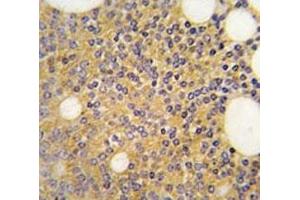 IHC analysis of FFPE human prostate carcinoma tissue stained with PRMT3 antibody (PRMT3 anticorps  (AA 460-491))