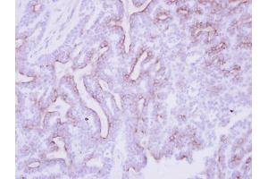 IHC-P Image Immunohistochemical analysis of paraffin-embedded human breast cancer, using CDO, antibody at 1:250 dilution.