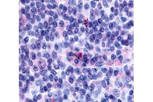 Anti-GPR65 antibody  ABIN1048859 IHC staining of human lymph node, hodgkin's disease. (GPR65 anticorps  (Cytoplasmic Domain))