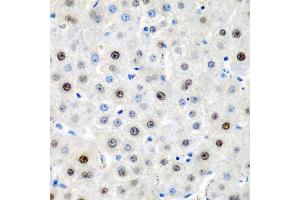 Immunohistochemistry of paraffin-embedded human liver cancer using LMX1B antibody (ABIN5975264) at dilution of 1/200 (40x lens). (LMX1B anticorps)