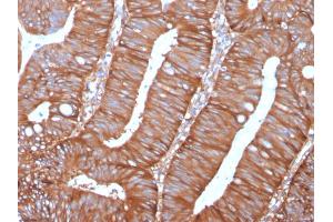 Formalin-fixed, paraffin-embedded human Colon Carcinoma stained with Calpastatin Mouse Monoclonal Antibody (CAST/1550).